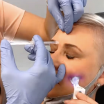 botox photo 6