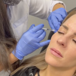 botox photo 7