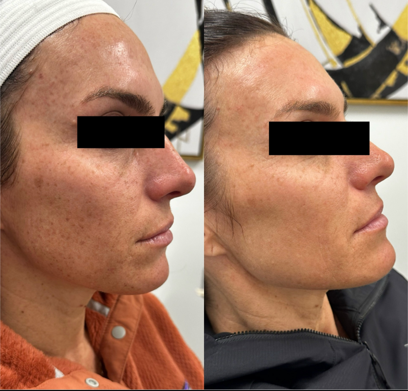 Before and After Image: IPL - right-front-oblique