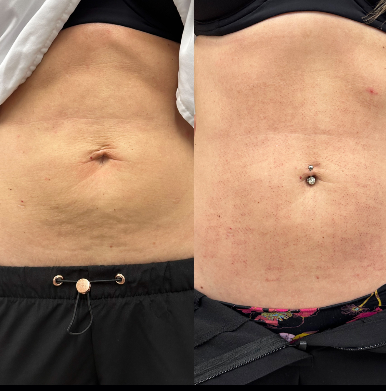Before and After Image: Morpheous8 - front