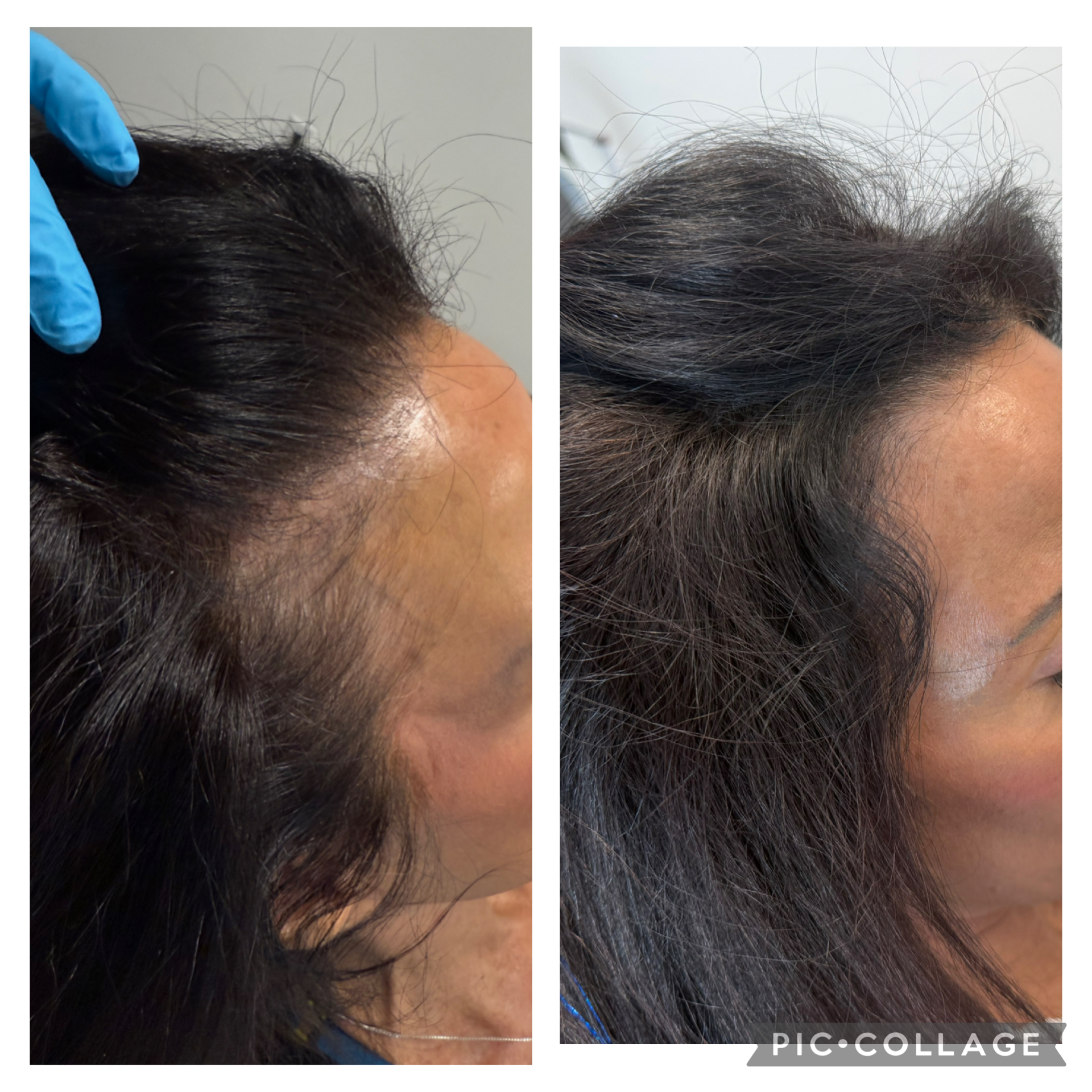 Before and After Image: Hair Restoration - right-side