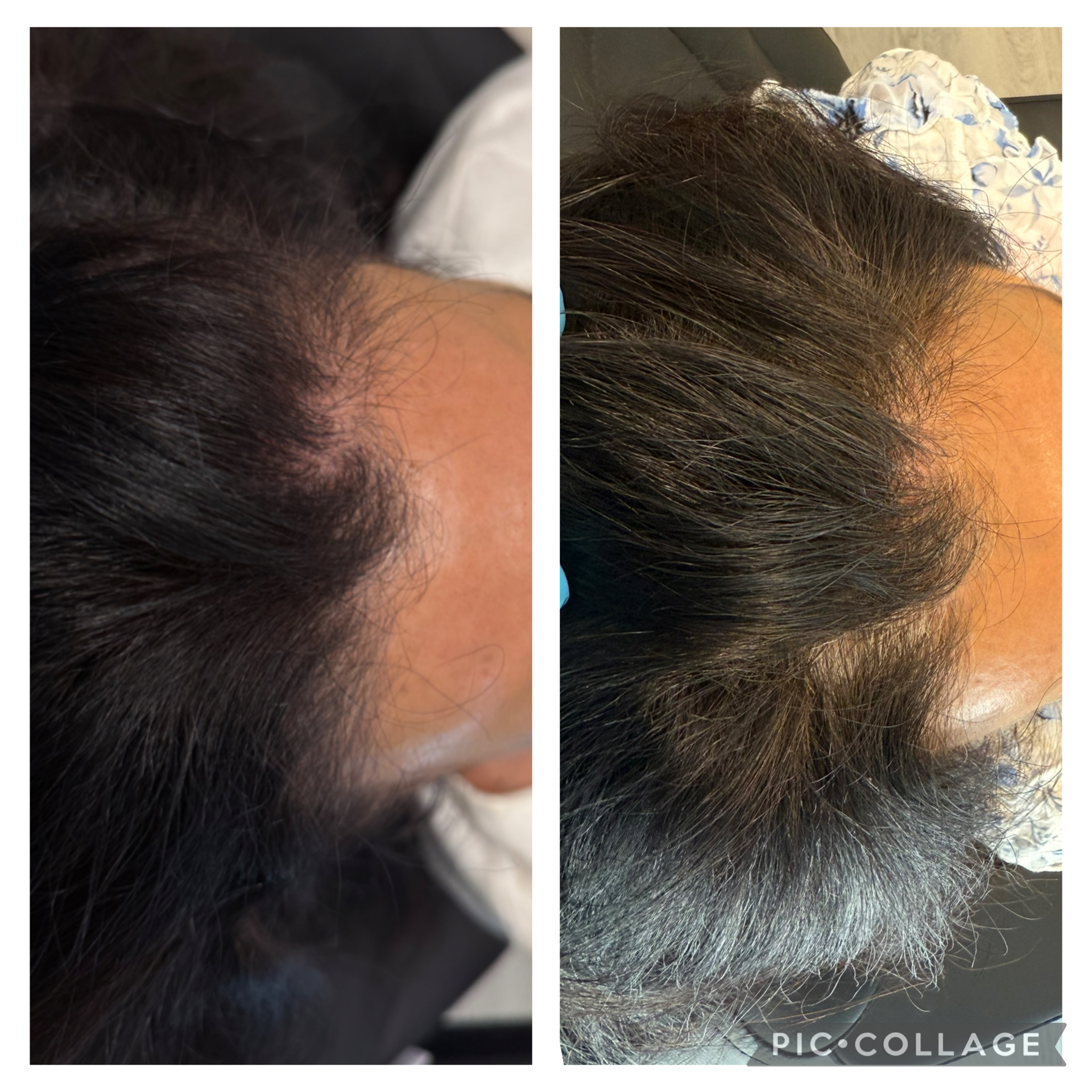 Before and After Image: Hair Restoration - right-side