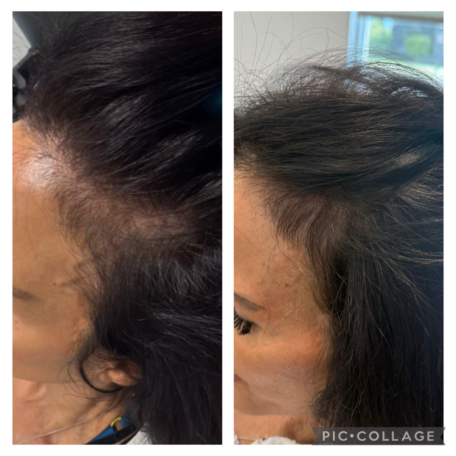 Before and After Image: Hair Restoration - left-side