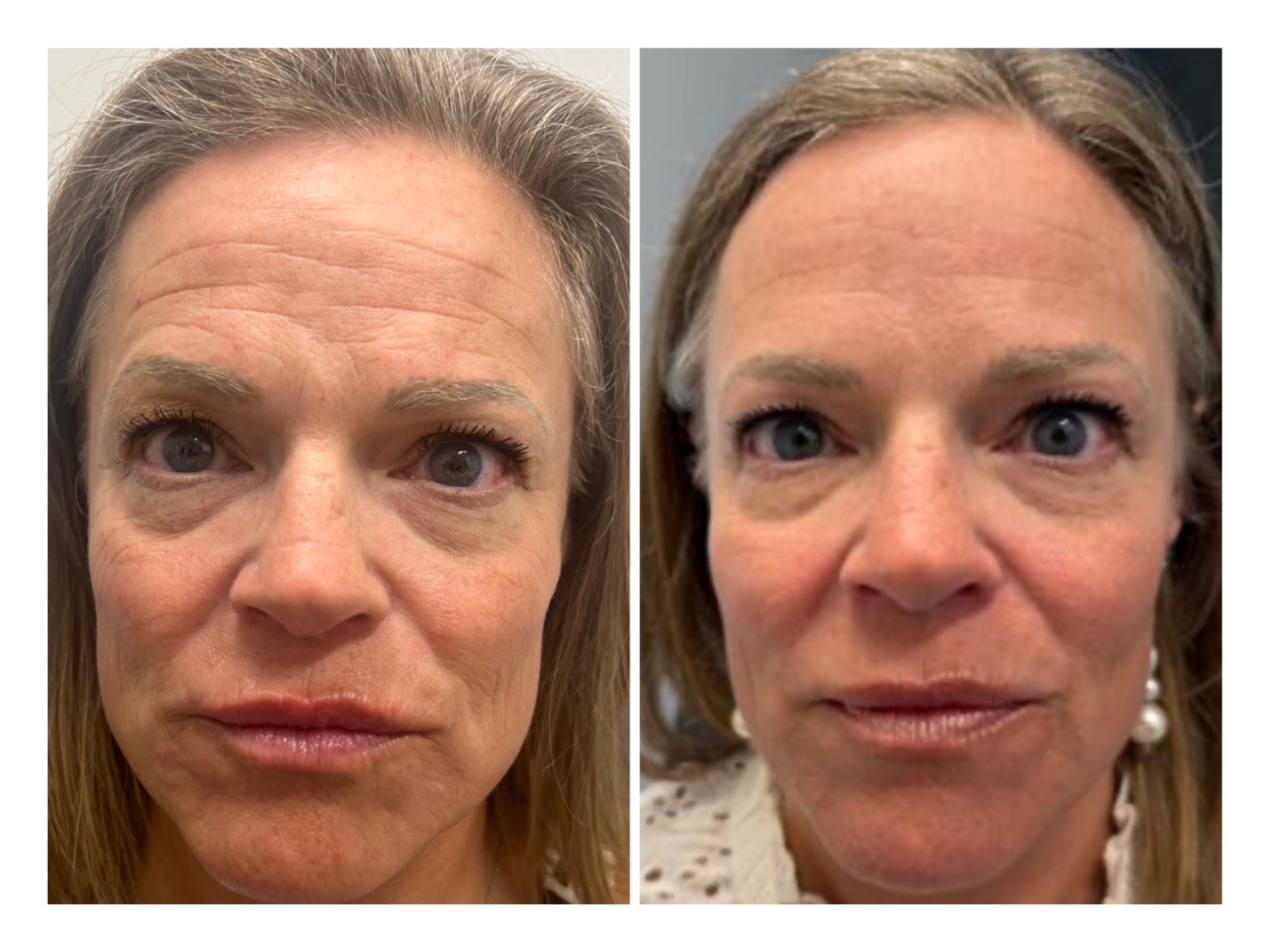 Before and After Image: UltraClear - front