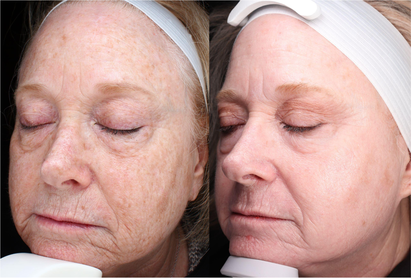 Before and After Image: UltraClear - left-front-oblique