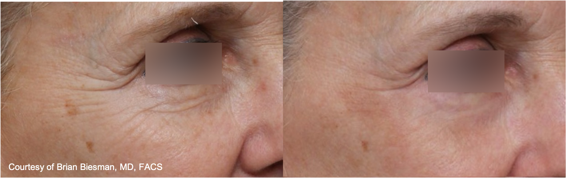 Before and After Image: UltraClear Eyes - right-front-oblique