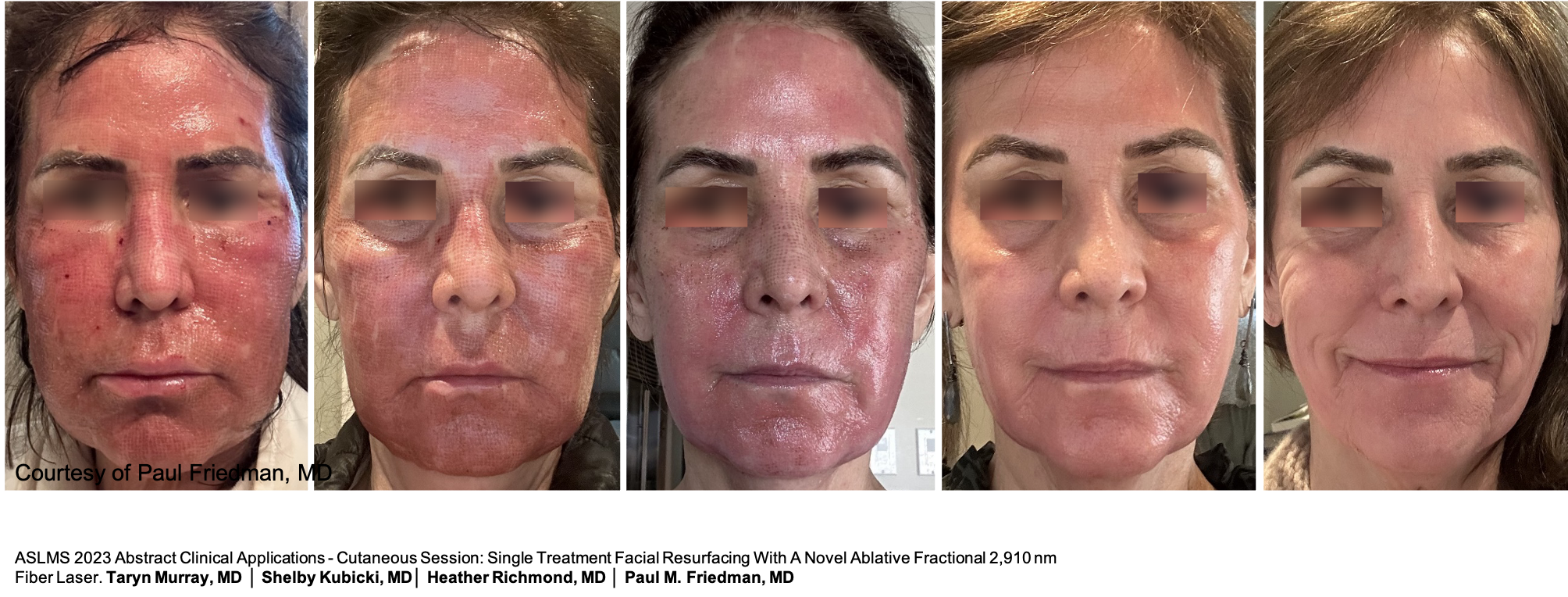 Before and After Image: UltraClear Healing Progression - front