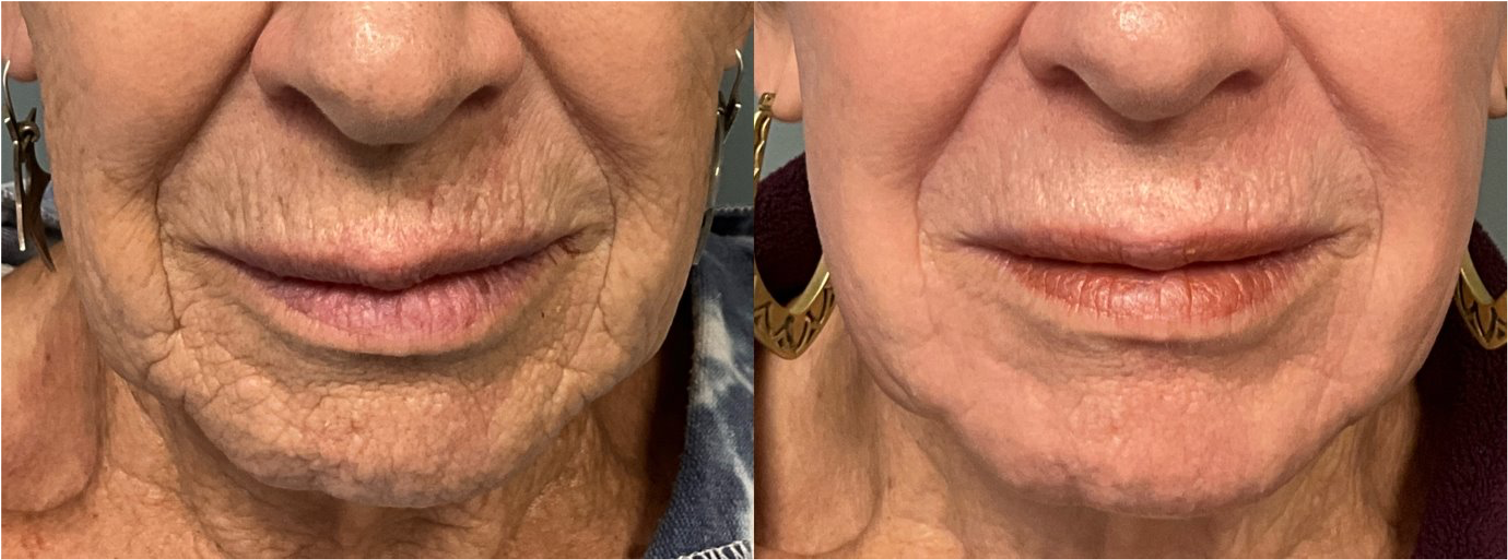 Before and After Image: UltraClear + Laser-Coring - front