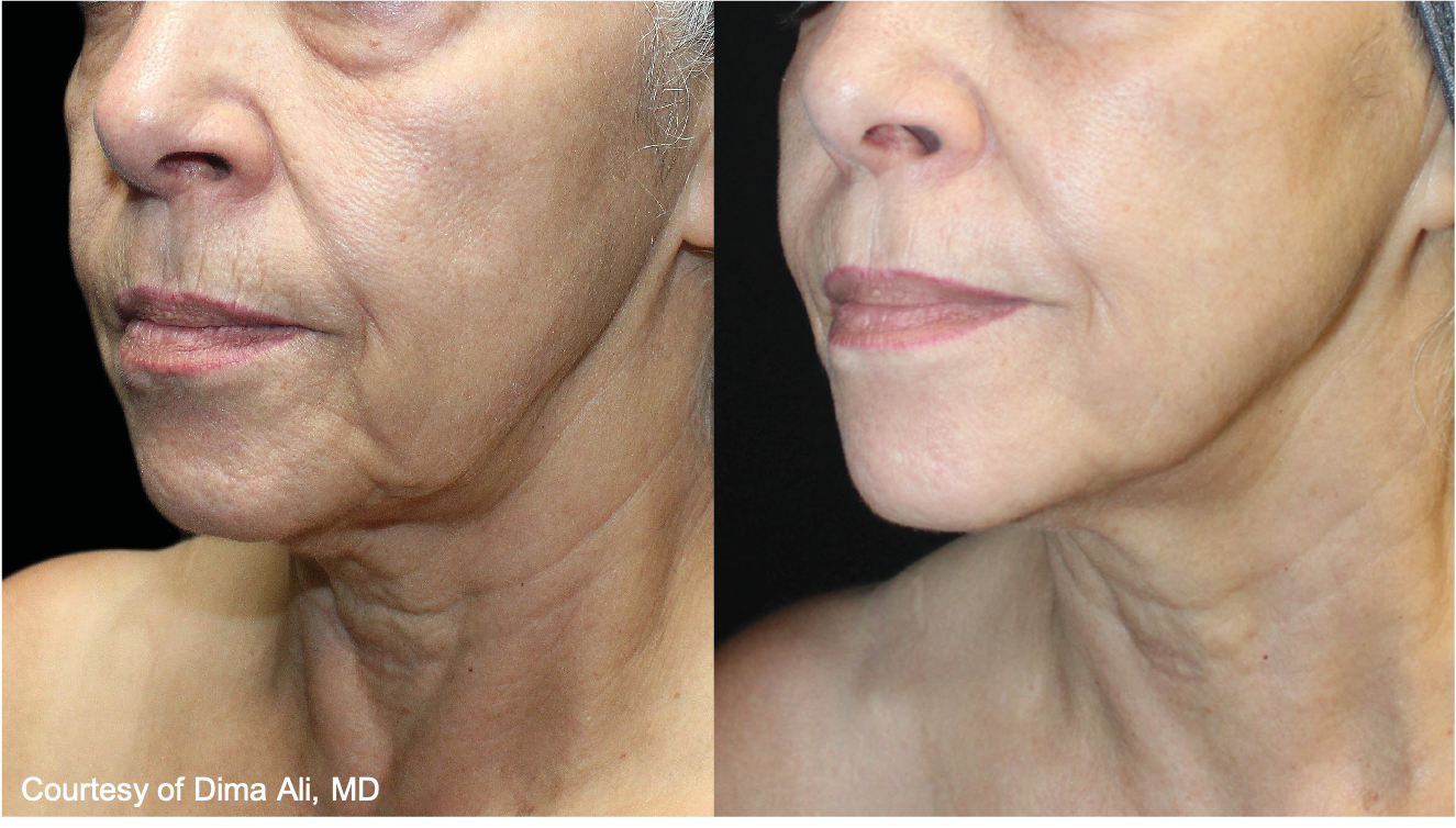Before and After Image: UltraClear - left-front-oblique