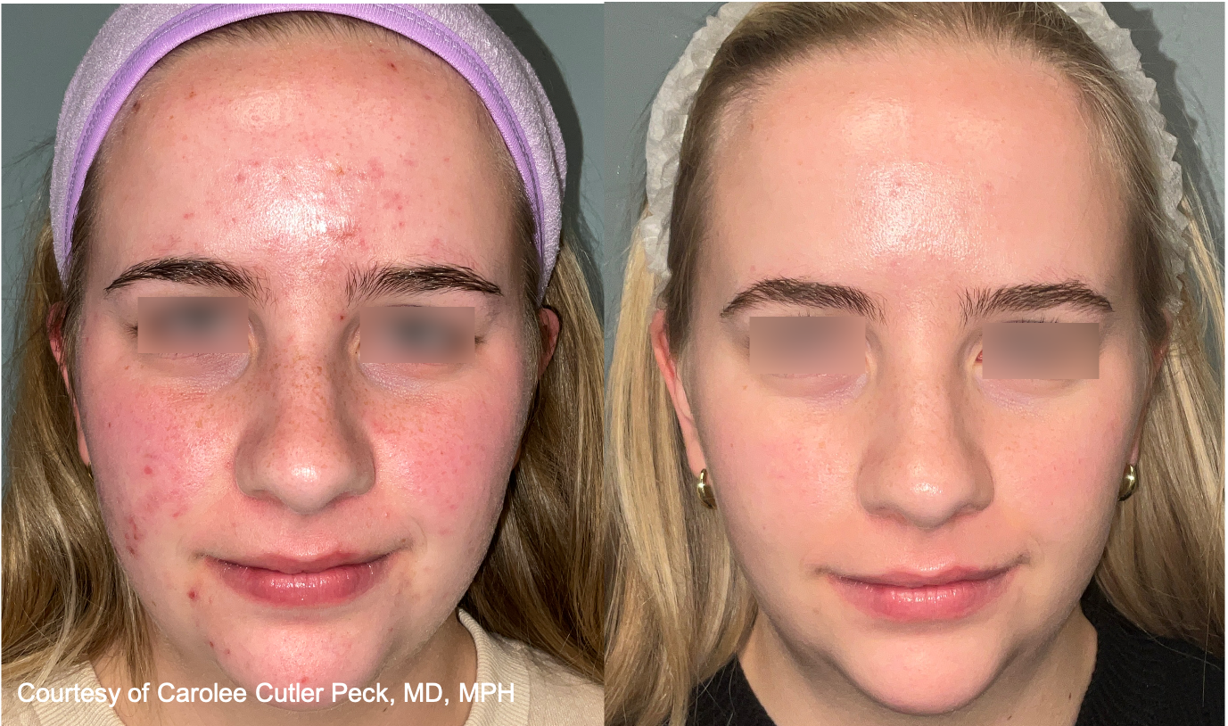 Before and After Image: UltraClear - front