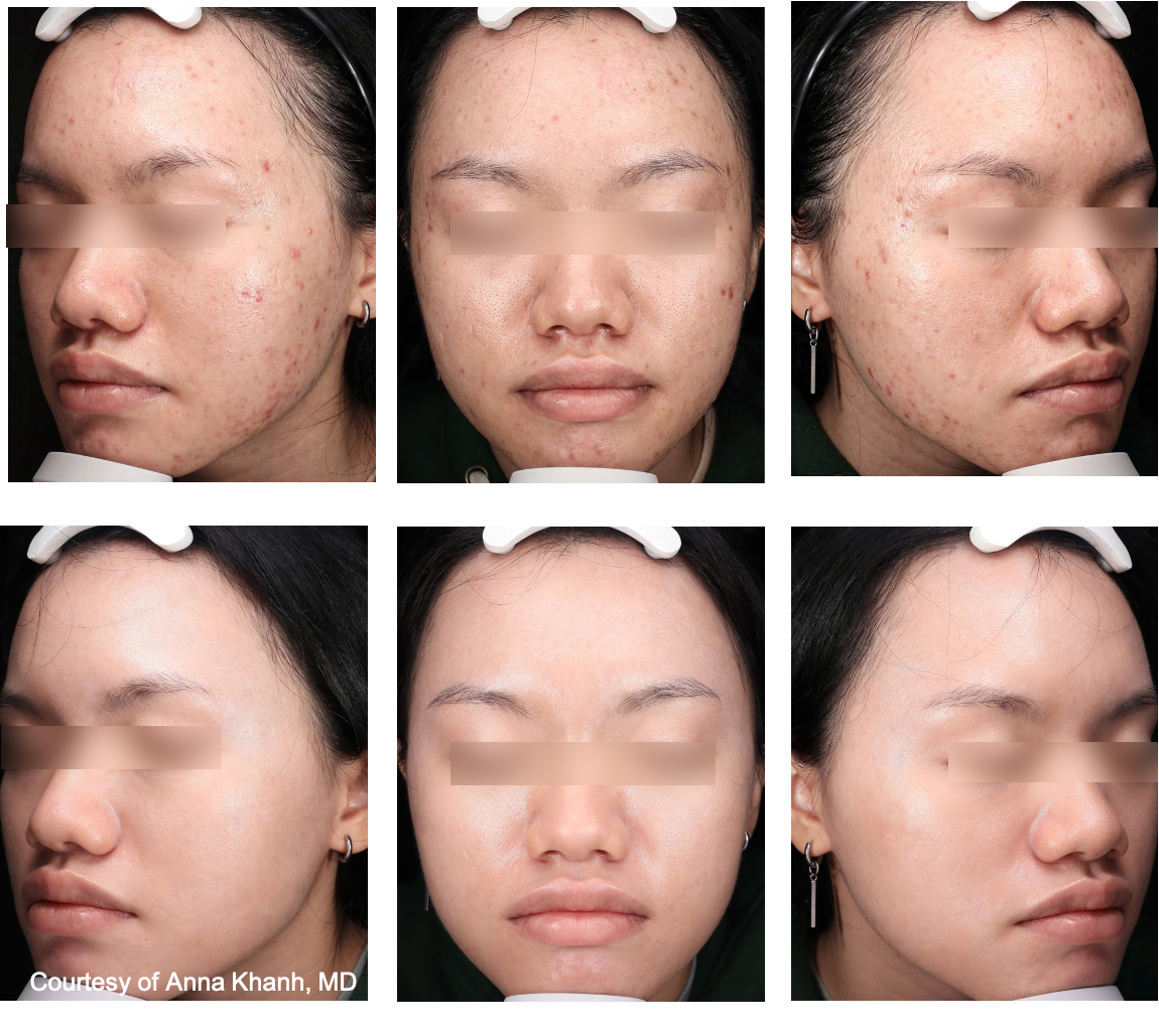 Before and After Image: UltraClear - front