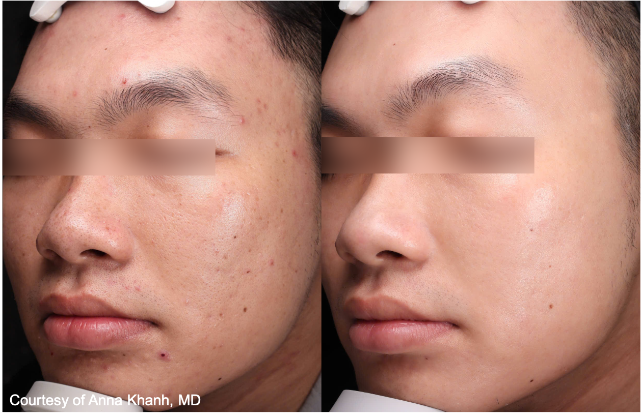 Before and After Image: UltraClear - 