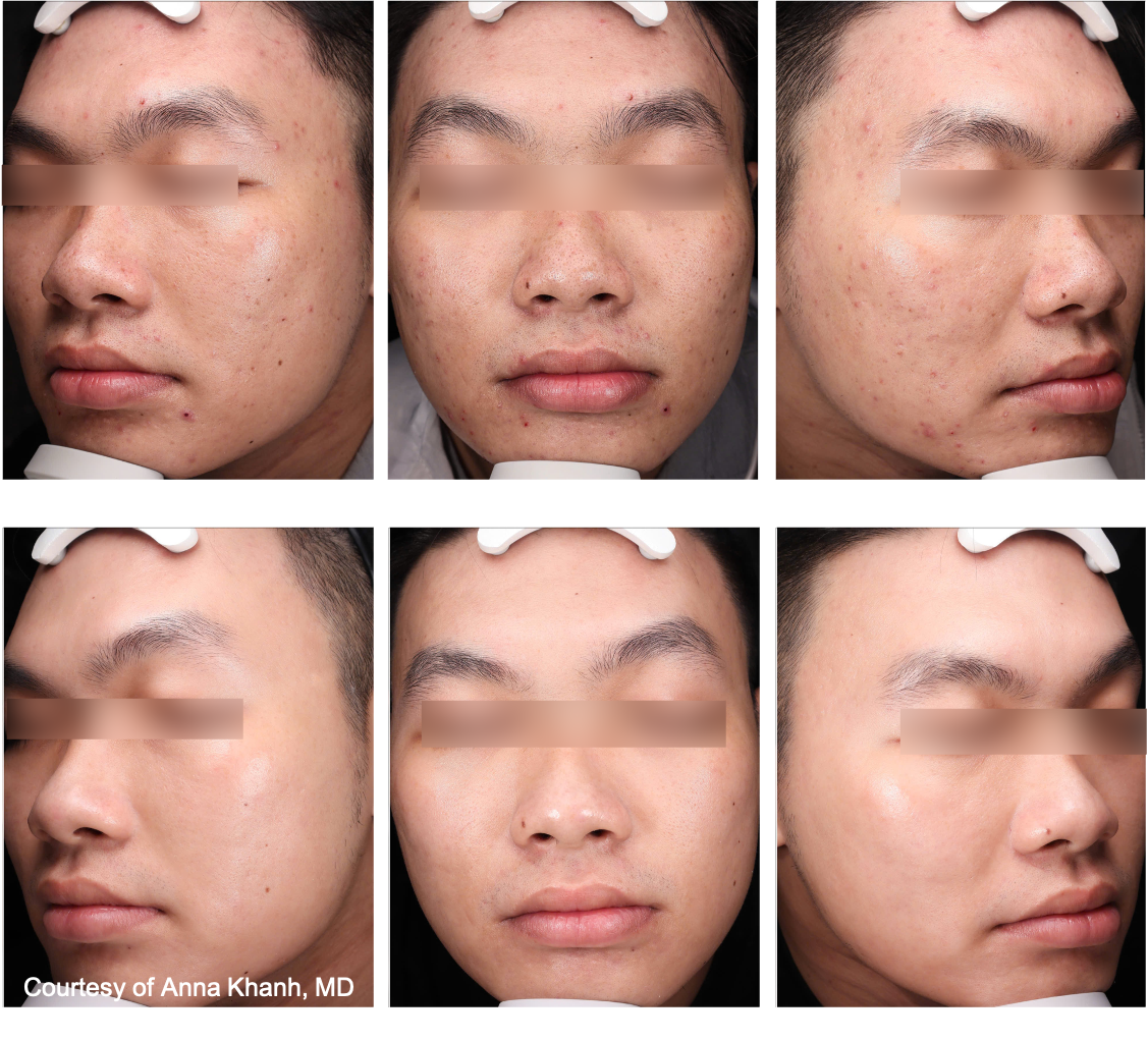 Before and After Image: UltraClear - front