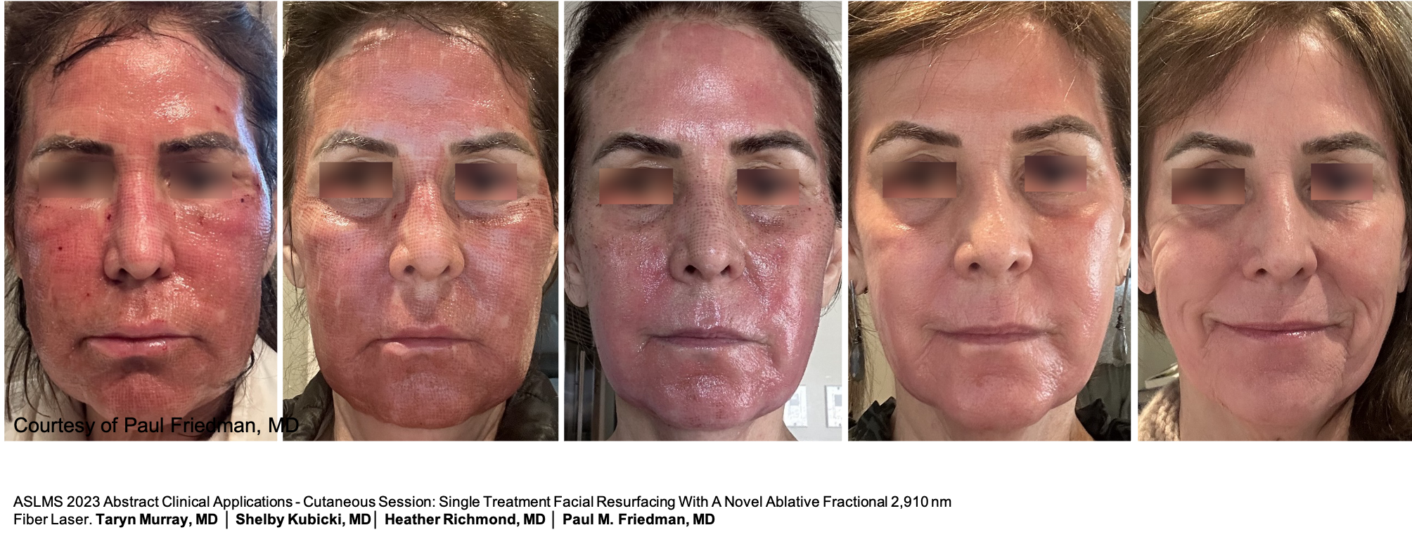 Before and After Image: UltraClear - front