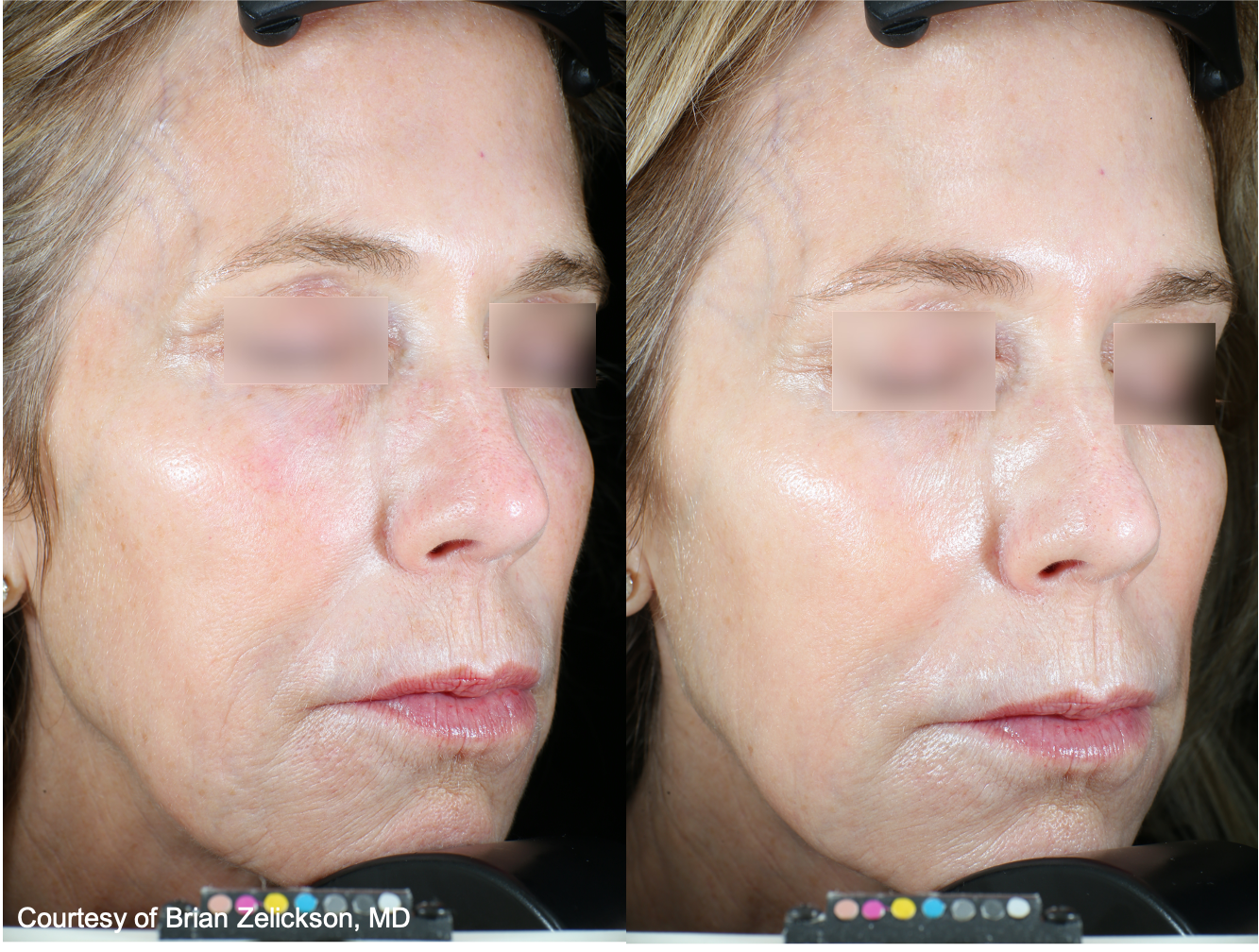 Before and After Image: UltraClear - right-front-oblique