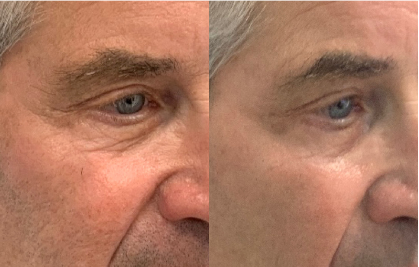 Before and After Image: UltraClear - right-front-oblique