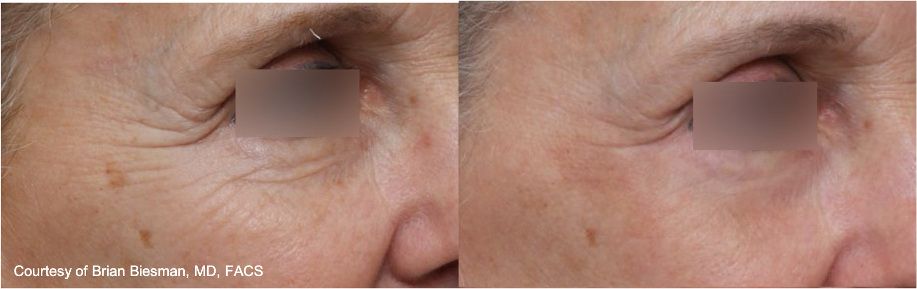 Before and After Image: UltraClear - right-front-oblique