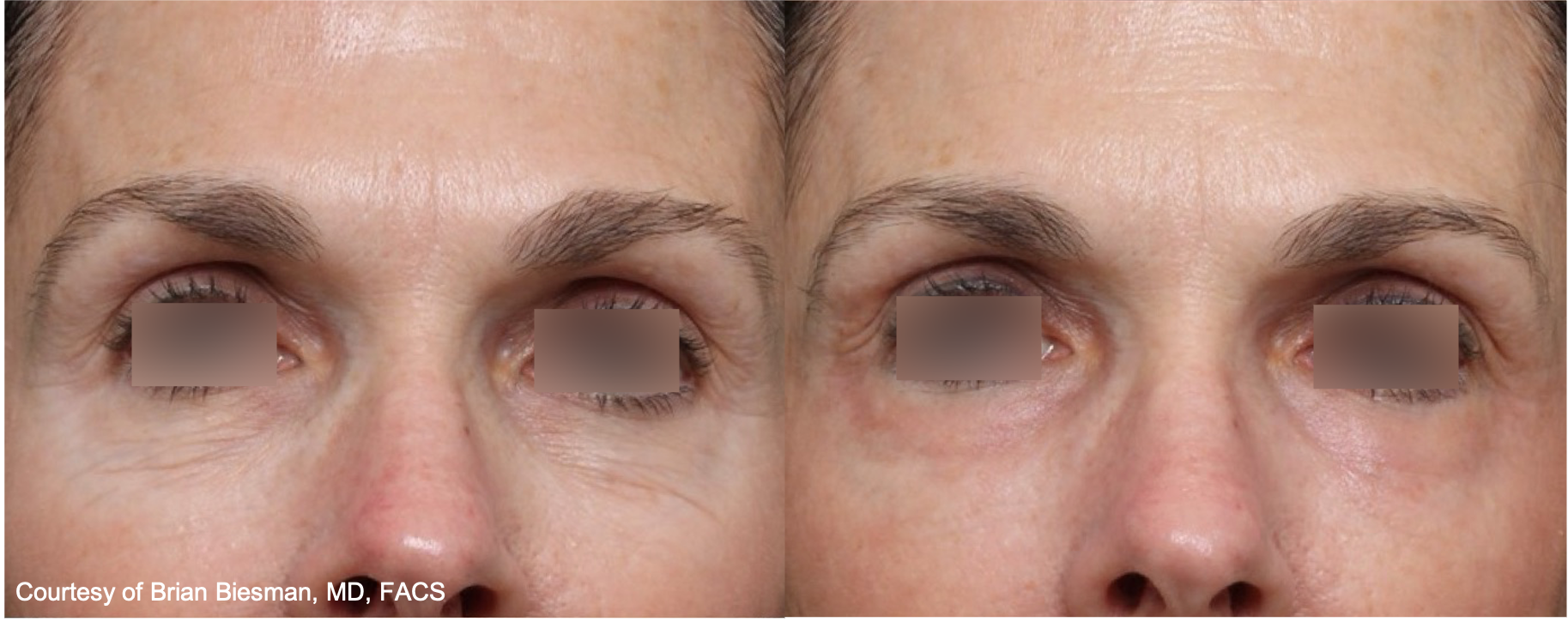Before and After Image: UltraClear - front