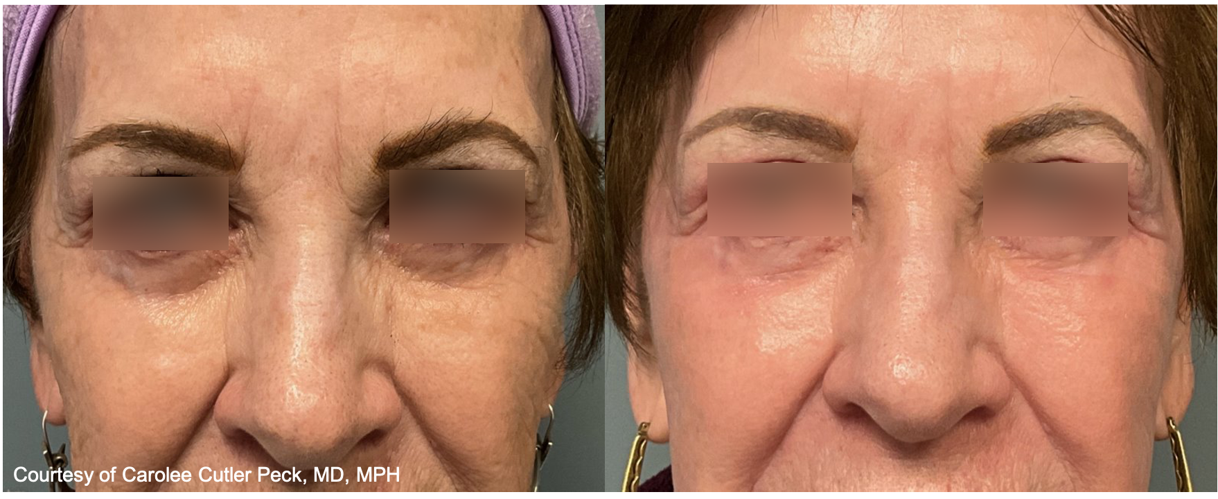 Before and After Image: UltraClear - front