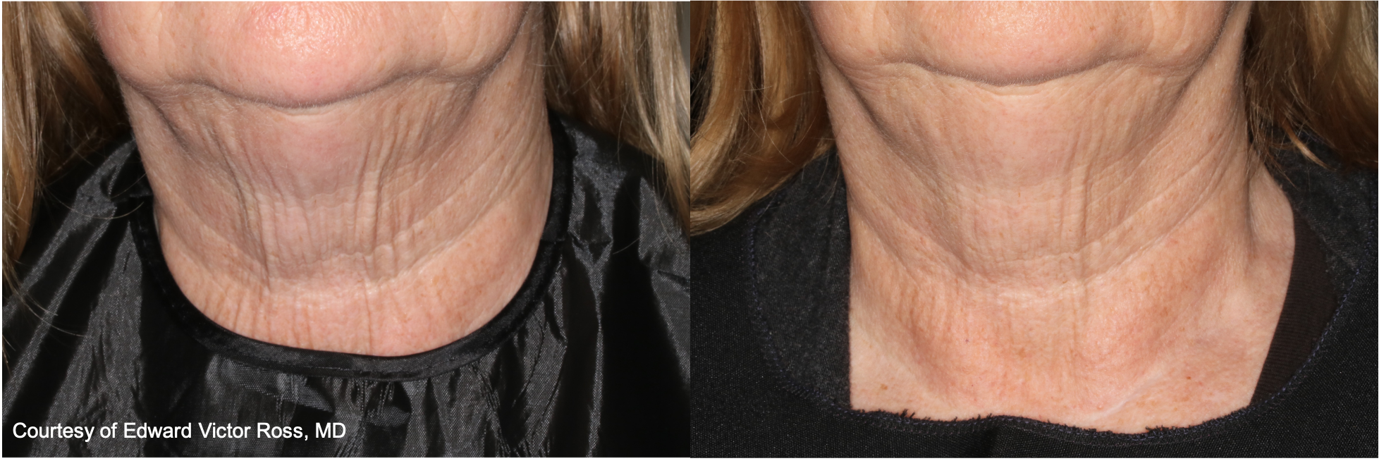 Before and After Image: UltraClear - front