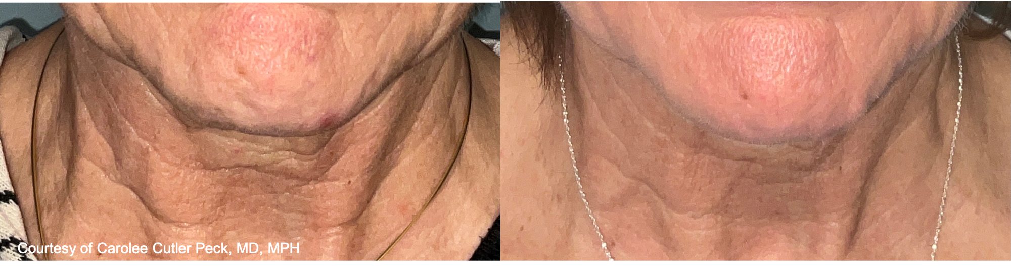 Before and After Image: UltraClear - front