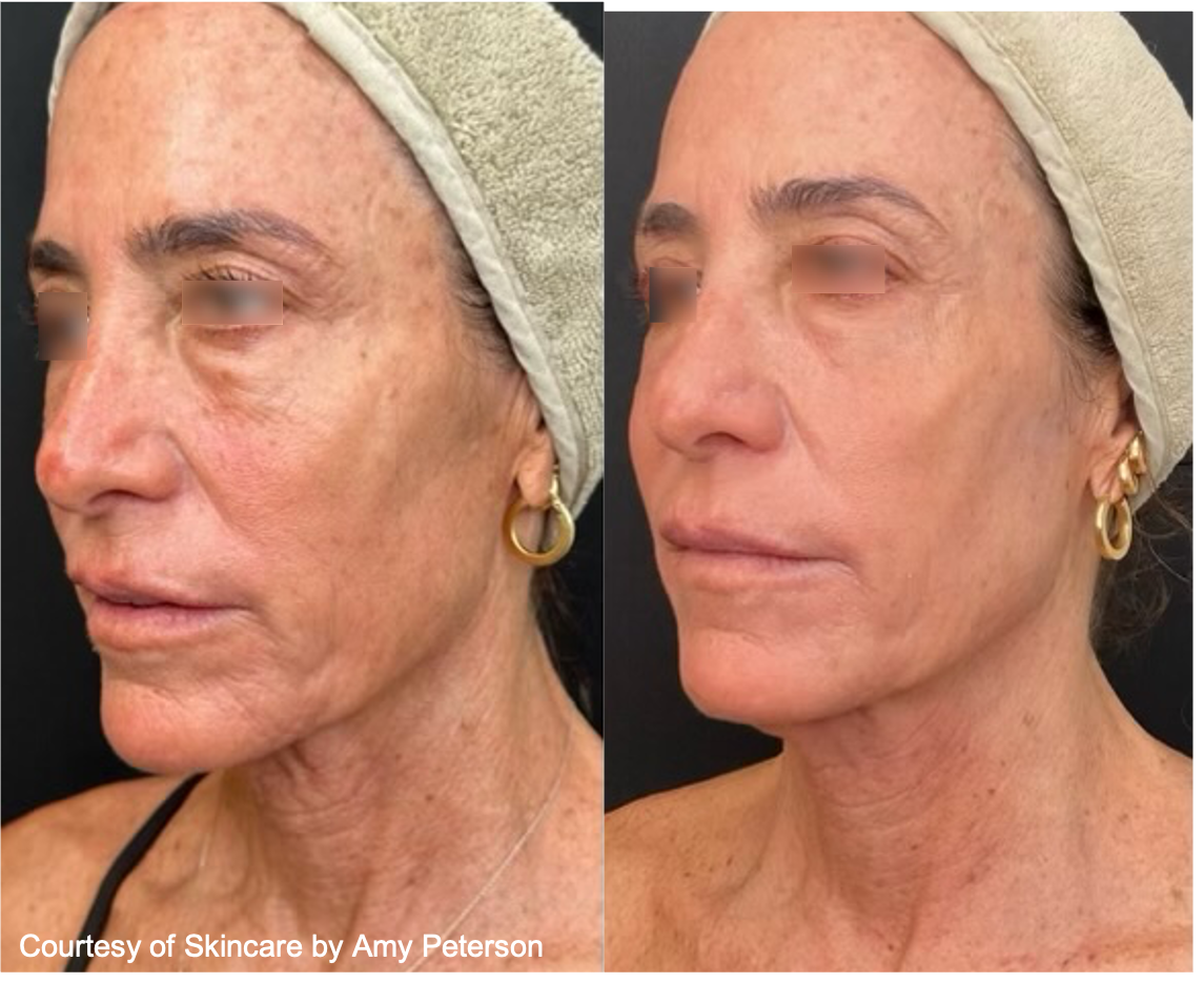 Before and After Image: UltraClear - left-front-oblique