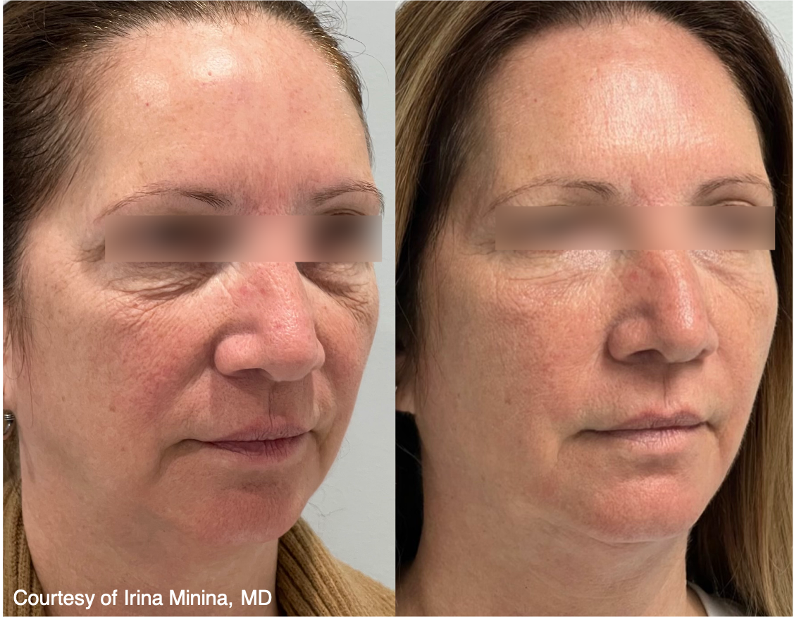 Before and After Image: UltraClear - right-front-oblique