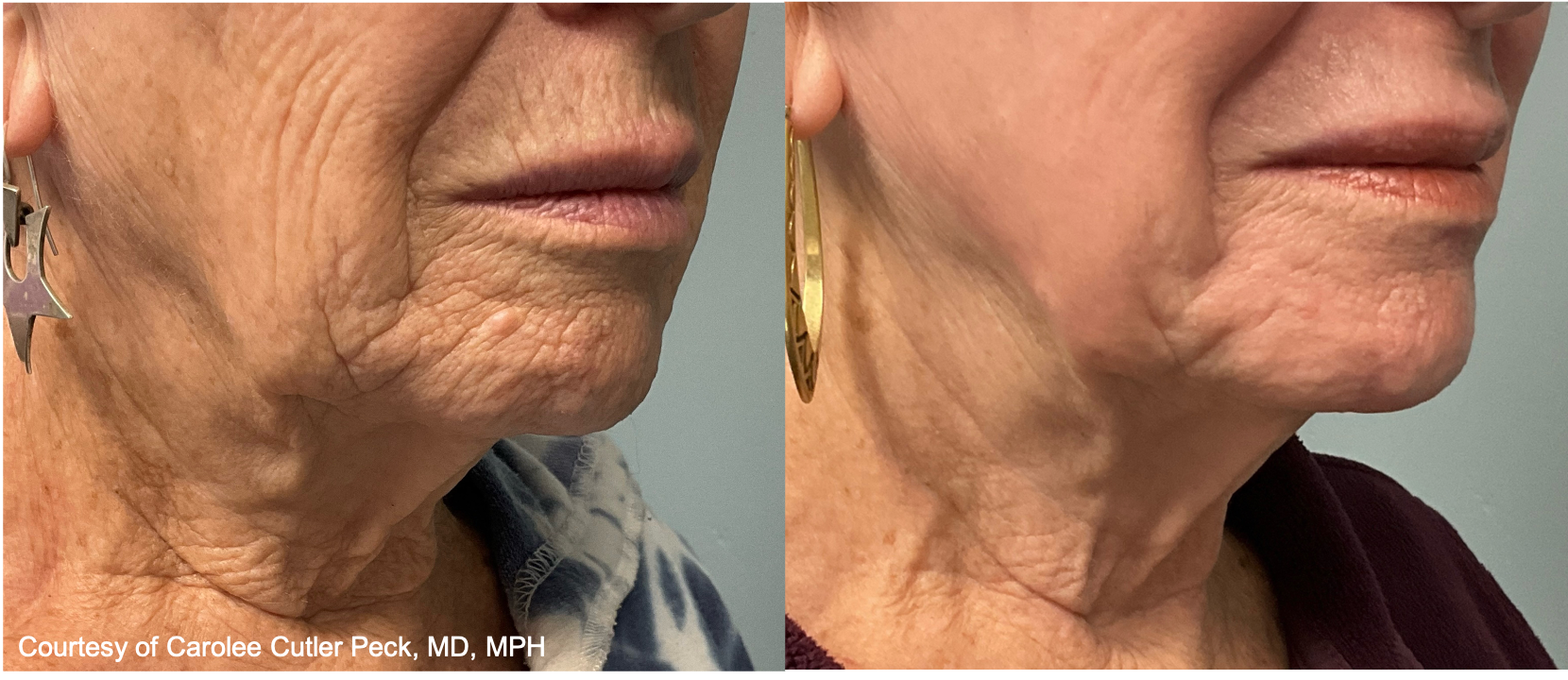 Before and After Image: UltraClear - right-front-oblique