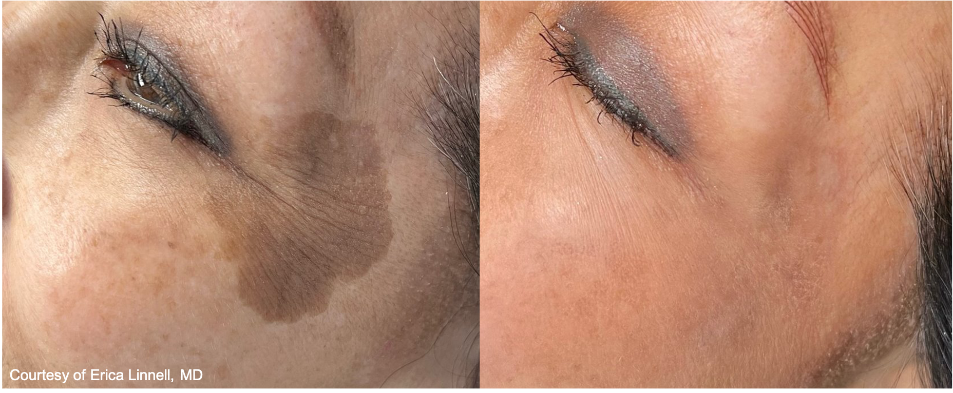 Before and After Image: UltraClear - left-front-oblique