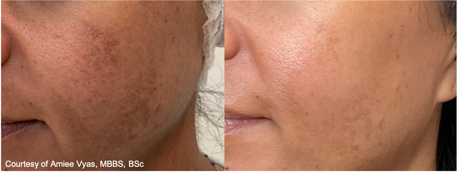 Before and After Image: UltraClear - left-front-oblique