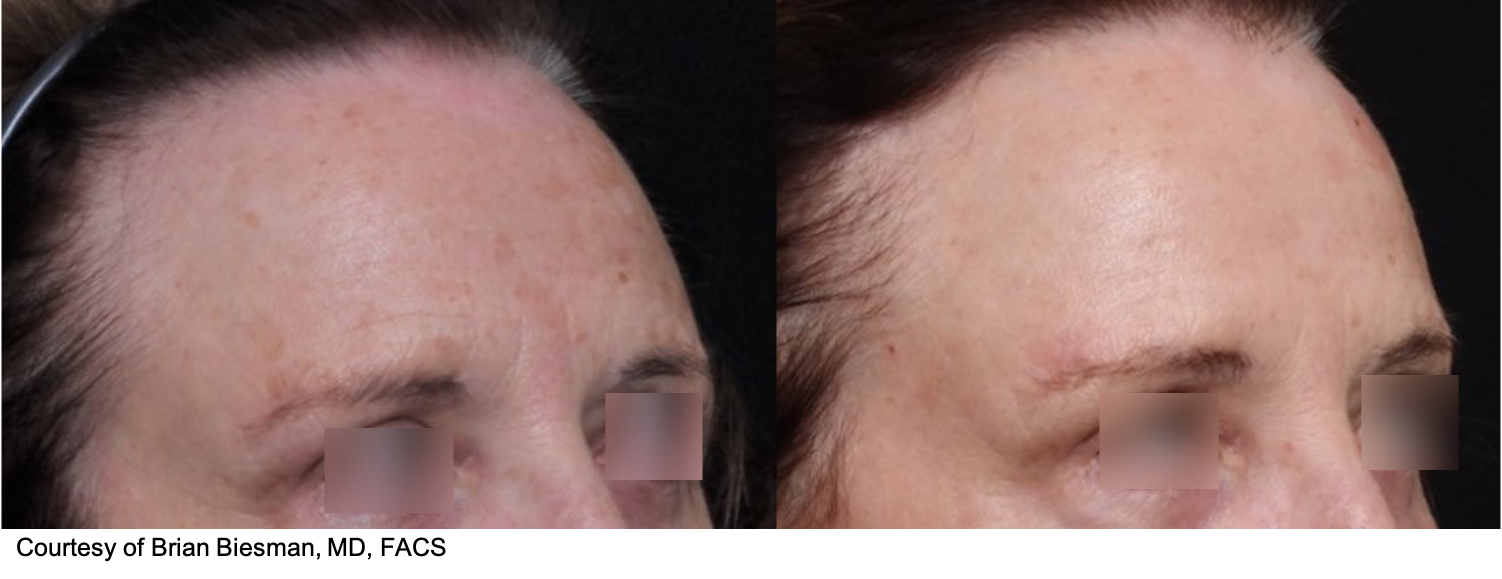 Before and After Image: UltraClear - right-front-oblique