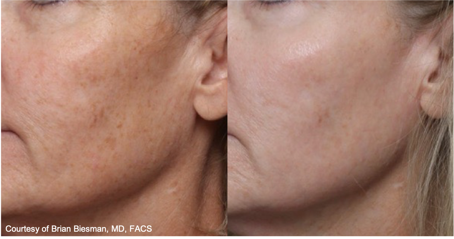 Before and After Image: UltraClear - left-front-oblique
