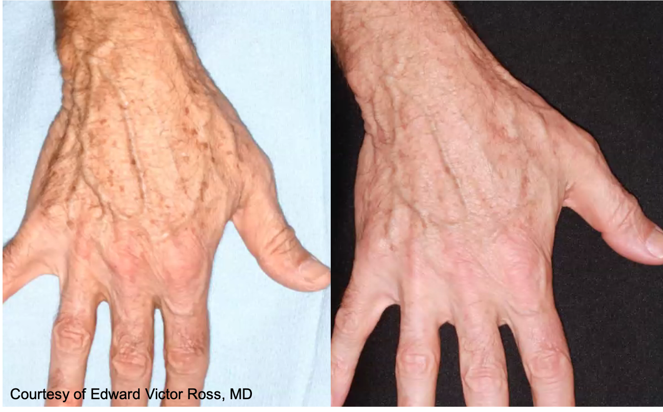 Before and After Image: UltraClear - front