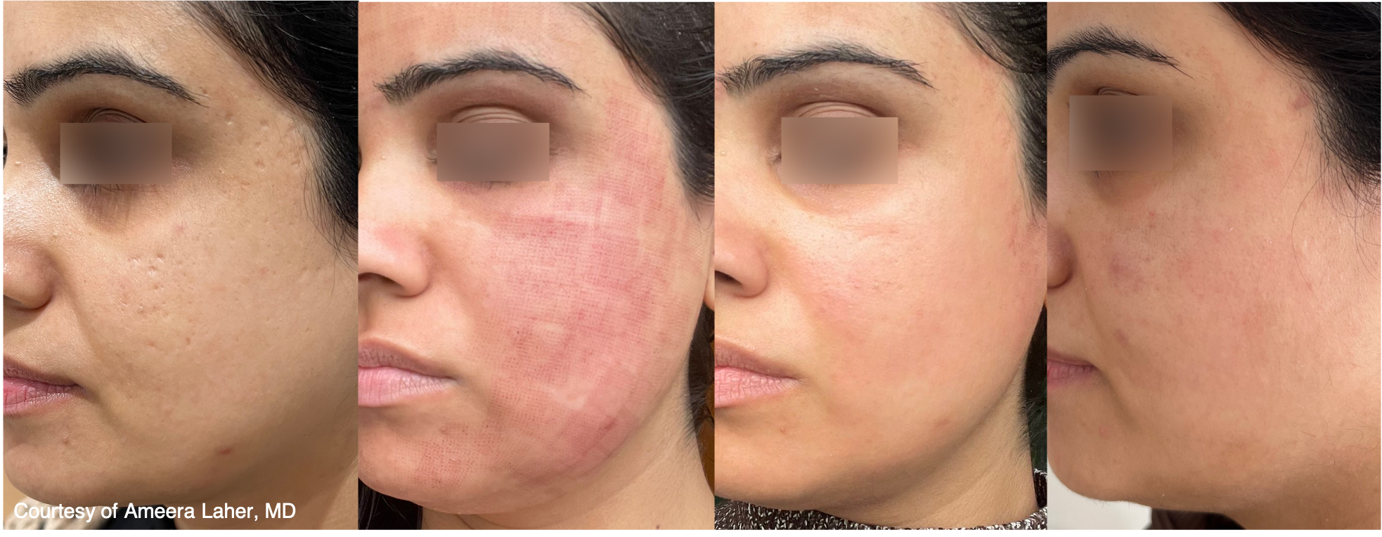 Before and After Image: UltraClear - left-front-oblique