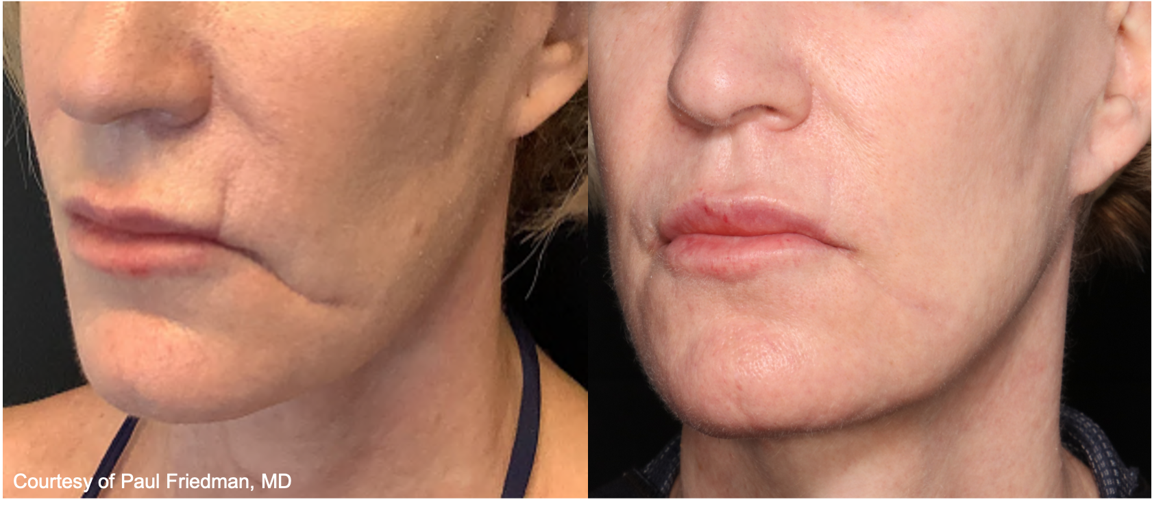 Before and After Image: UltraClear - left-front-oblique