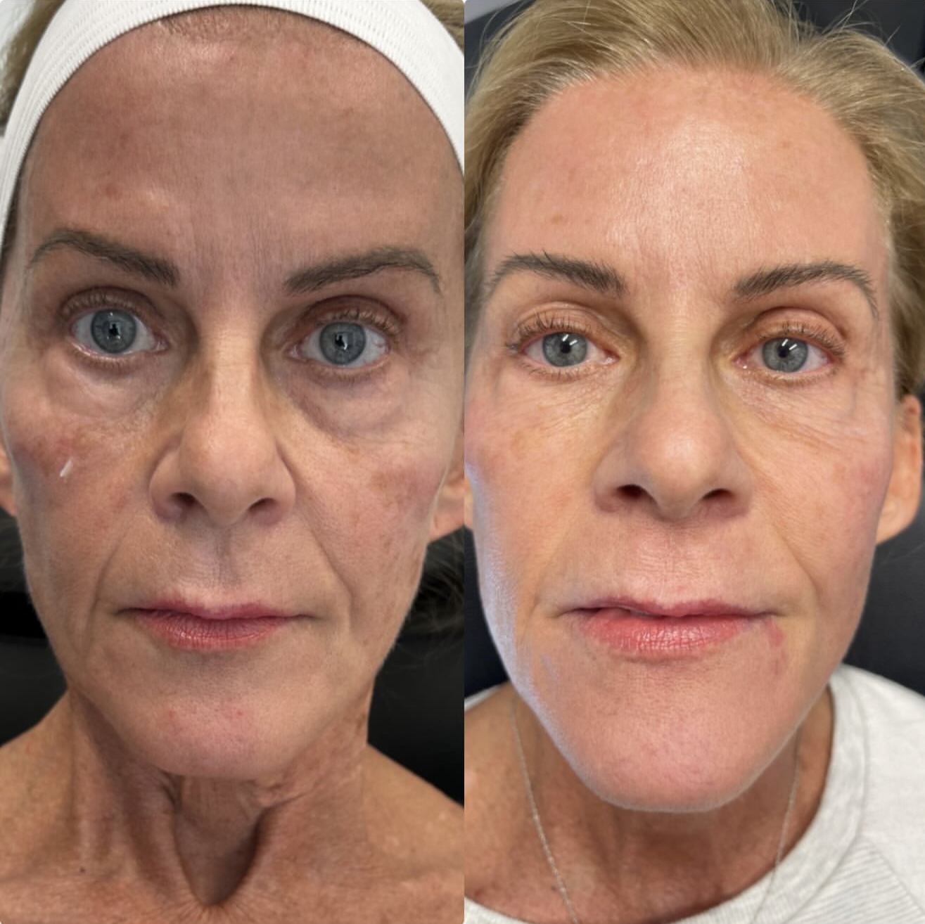 Before and After Image: UltraClear - front