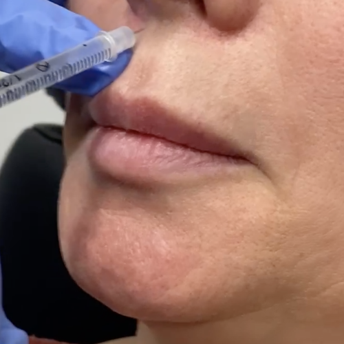 lip botox
