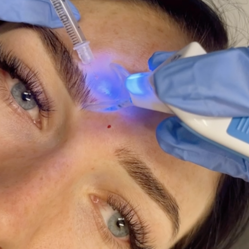botox eyebrow