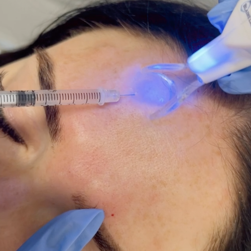 botox photo 4